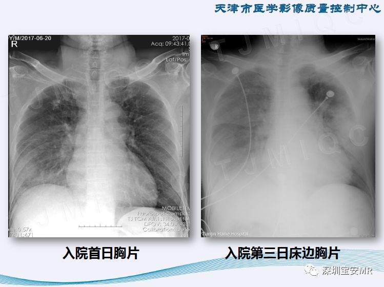 今天常州有人感染新型冠状（常州发现新型冠状肺炎）